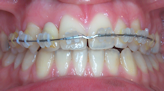 traitement orthodontiste courbevoie